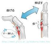 1腱鞘炎.jpg